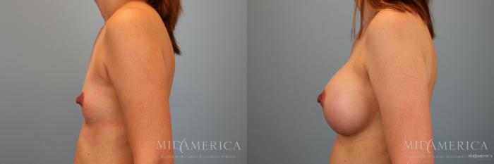 Before & After Breast Augmentation Case 39 View #3 View in Glen Carbon, IL