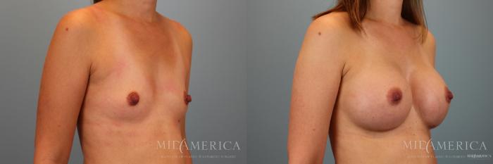 Before & After Breast Augmentation Case 39 View #4 View in Glen Carbon, IL