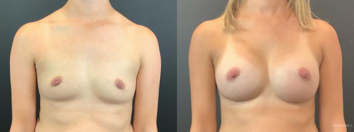 Before & After Breast Augmentation Case 393 Front View in St. Louis, MO