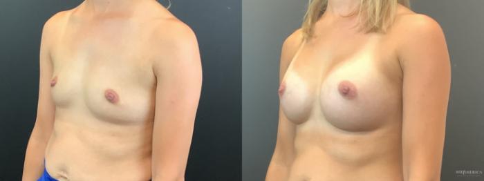 Before & After Breast Augmentation Case 393 Left Oblique View in St. Louis, MO