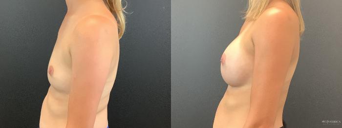 Before & After Breast Augmentation Case 393 Left Side View in St. Louis, MO
