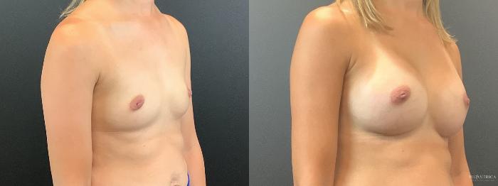 Before & After Breast Augmentation Case 393 Right Oblique View in St. Louis, MO