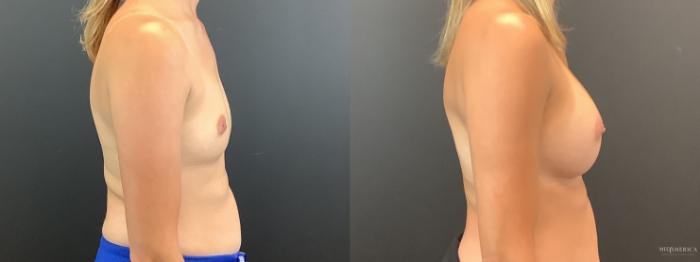 Before & After Breast Augmentation Case 393 Right Side View in St. Louis, MO