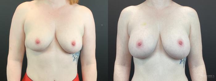 Before & After Breast Augmentation Case 398 Front View in St. Louis, MO