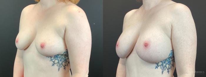 Before & After Breast Augmentation Case 398 Left Oblique View in St. Louis, MO