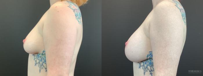 Before & After Breast Augmentation Case 398 Left Side View in St. Louis, MO