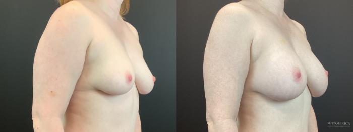 Before & After Breast Augmentation Case 398 Right Oblique View in St. Louis, MO