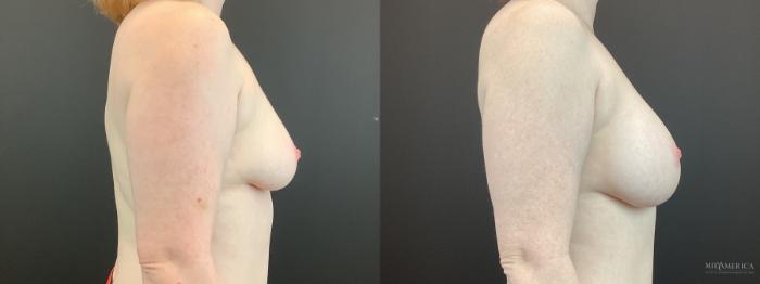 Before & After Breast Augmentation Case 398 Right Side View in St. Louis, MO