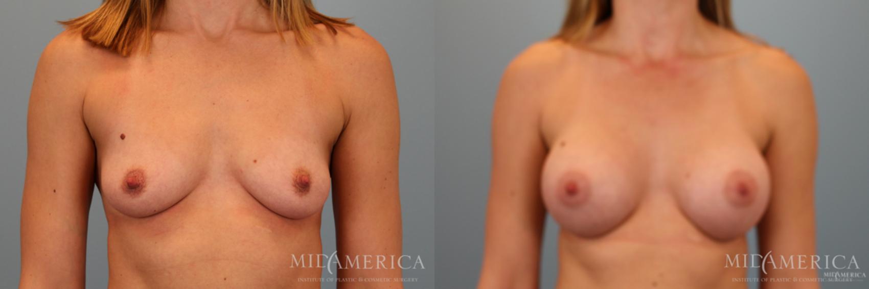 Before & After Breast Augmentation Case 46 View #1 View in St. Louis, MO