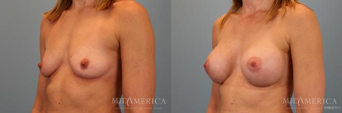 Before & After Breast Augmentation Case 46 View #2 View in St. Louis, MO