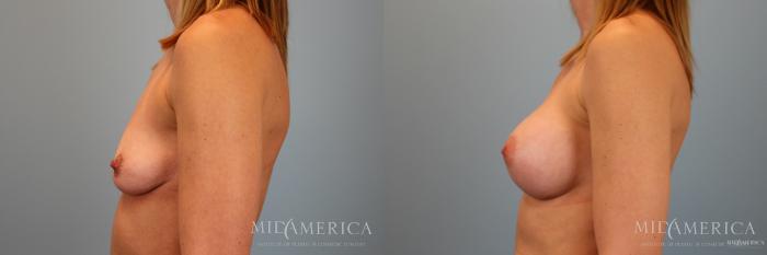 Before & After Breast Augmentation Case 46 View #3 View in St. Louis, MO