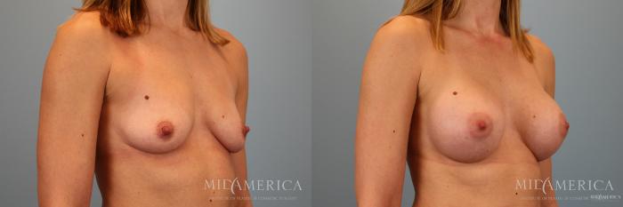 Before & After Breast Augmentation Case 46 View #4 View in St. Louis, MO