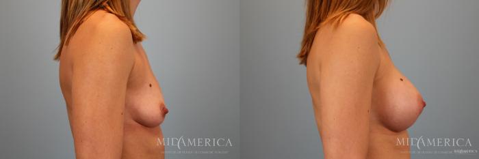 Before & After Breast Augmentation Case 46 View #5 View in St. Louis, MO