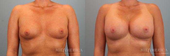 Before & After Breast Augmentation Case 48 View #1 View in Glen Carbon, IL