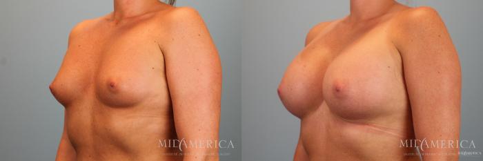 Before & After Breast Augmentation Case 48 View #2 View in Glen Carbon, IL