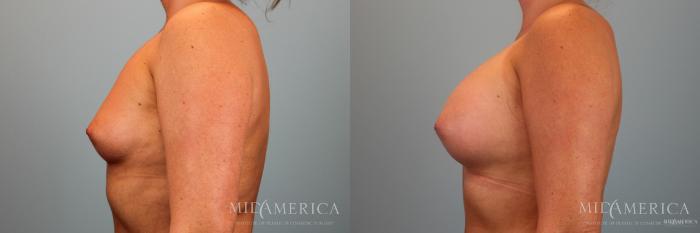 Before & After Breast Augmentation Case 48 View #3 View in Glen Carbon, IL
