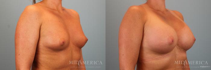 Before & After Breast Augmentation Case 48 View #4 View in Glen Carbon, IL
