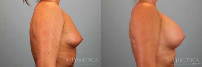Before & After Breast Augmentation Case 48 View #5 View in Glen Carbon, IL