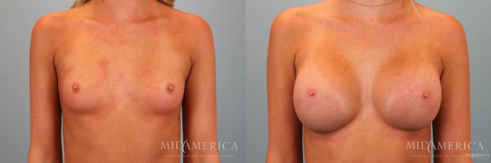Before & After Breast Augmentation Case 52 View #1 View in Glen Carbon, IL