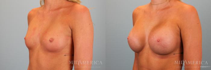 Before & After Breast Augmentation Case 52 View #2 View in Glen Carbon, IL