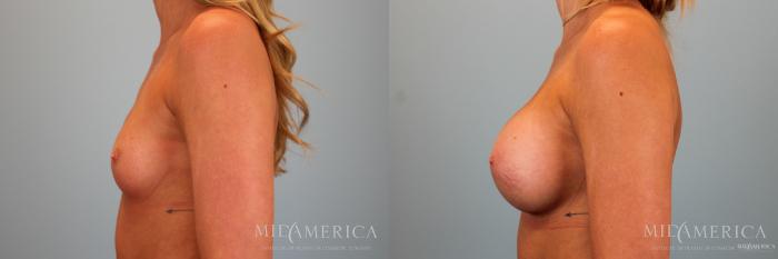 Before & After Breast Augmentation Case 52 View #3 View in Glen Carbon, IL