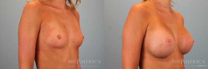 Before & After Breast Augmentation Case 52 View #4 View in Glen Carbon, IL