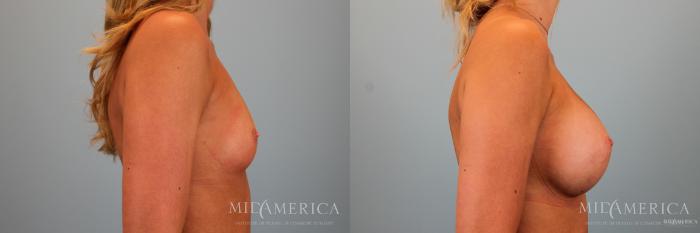 Before & After Breast Augmentation Case 52 View #5 View in Glen Carbon, IL