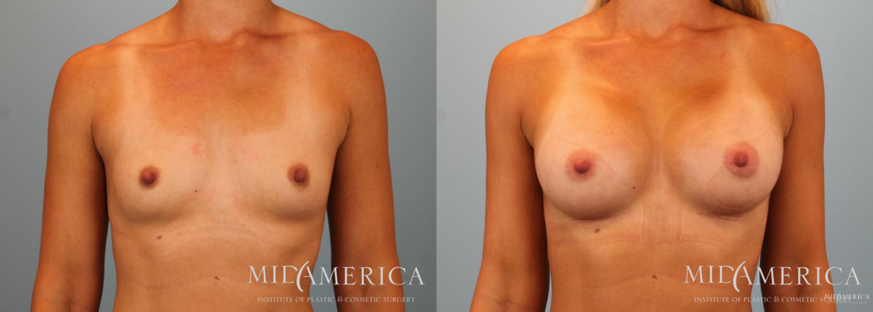 Before & After Breast Augmentation Case 53 View #1 View in Glen Carbon, IL