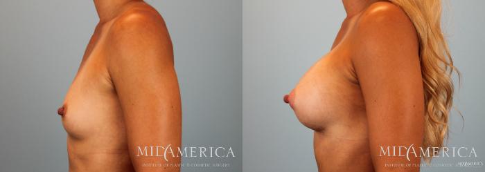 Before & After Breast Augmentation Case 53 View #3 View in Glen Carbon, IL