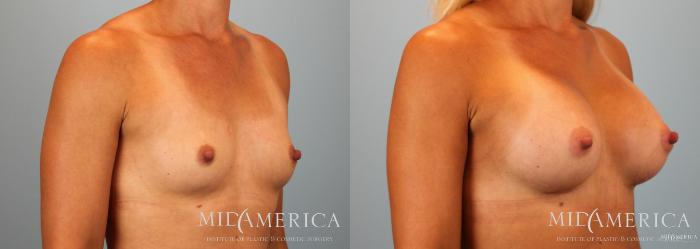 Before & After Breast Augmentation Case 53 View #4 View in Glen Carbon, IL