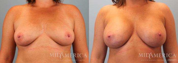 Before & After Breast Augmentation Case 61 View #1 View in St. Louis, MO