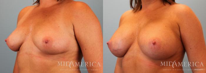 Before & After Breast Augmentation Case 61 View #2 View in St. Louis, MO
