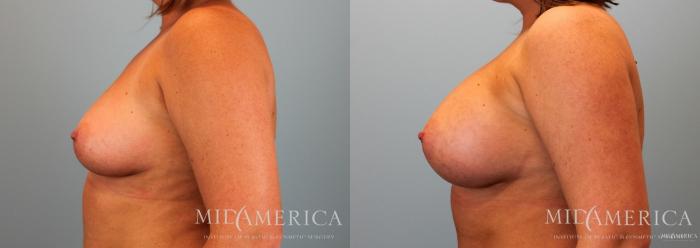 Before & After Breast Augmentation Case 61 View #3 View in St. Louis, MO