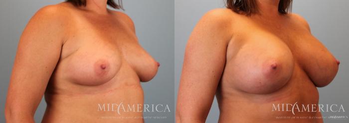 Before & After Breast Augmentation Case 61 View #4 View in St. Louis, MO