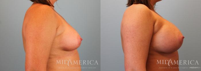 Before & After Breast Augmentation Case 61 View #5 View in St. Louis, MO