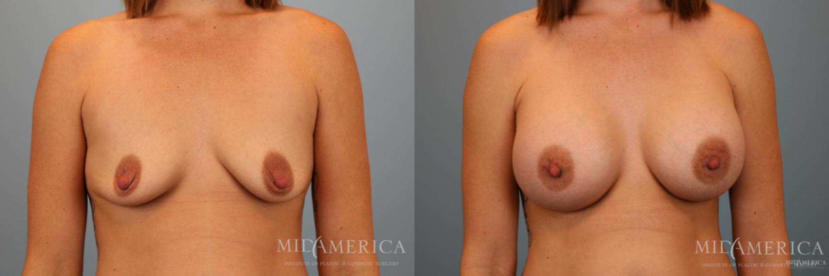 Before & After Breast Augmentation Case 68 View #1 View in Glen Carbon, IL