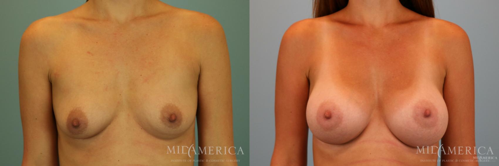 Before & After Breast Augmentation Case 69 View #1 View in Glen Carbon, IL