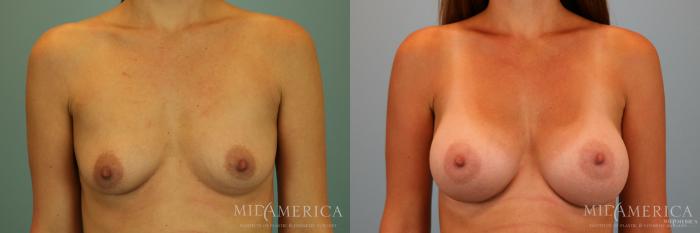 Before & After Breast Augmentation Case 69 View #1 View in St. Louis, MO
