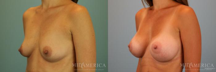 Before & After Breast Augmentation Case 69 View #2 View in St. Louis, MO