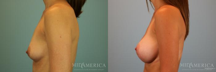 Before & After Breast Augmentation Case 69 View #3 View in St. Louis, MO