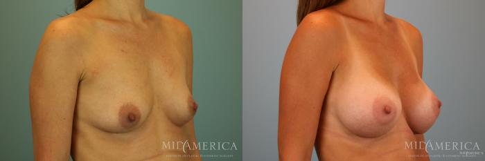 Before & After Breast Augmentation Case 69 View #4 View in St. Louis, MO