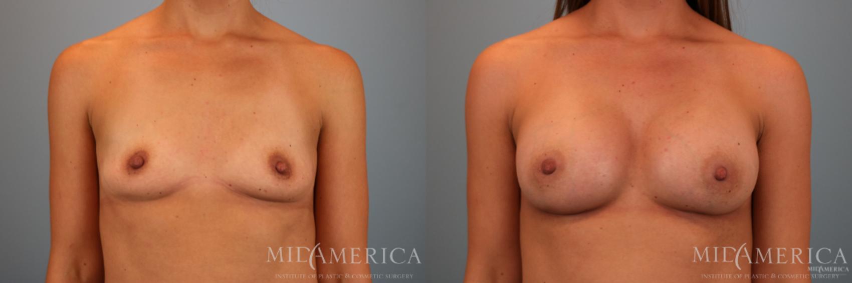 Before & After Breast Augmentation Case 70 View #1 View in St. Louis, MO