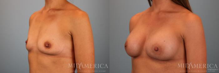 Before & After Breast Augmentation Case 70 View #2 View in St. Louis, MO