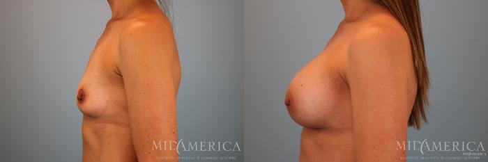 Before & After Breast Augmentation Case 70 View #3 View in St. Louis, MO