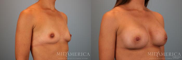 Before & After Breast Augmentation Case 70 View #4 View in St. Louis, MO