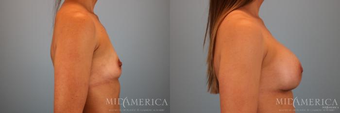 Before & After Breast Augmentation Case 70 View #5 View in St. Louis, MO