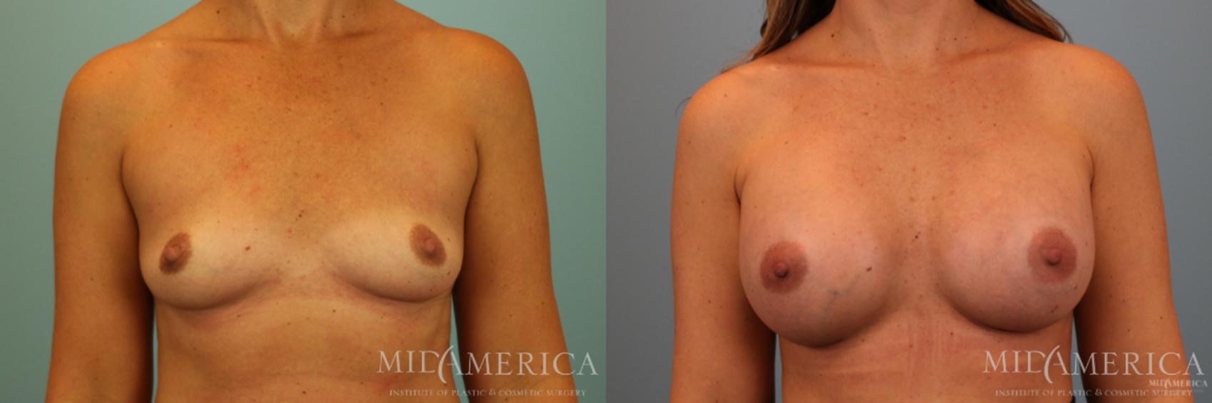 Before & After Breast Augmentation Case 74 View #1 View in Glen Carbon, IL