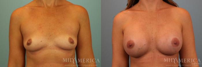 Before & After Breast Augmentation Case 74 View #1 View in Glen Carbon, IL