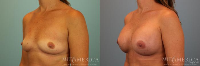 Before & After Breast Augmentation Case 74 View #2 View in Glen Carbon, IL