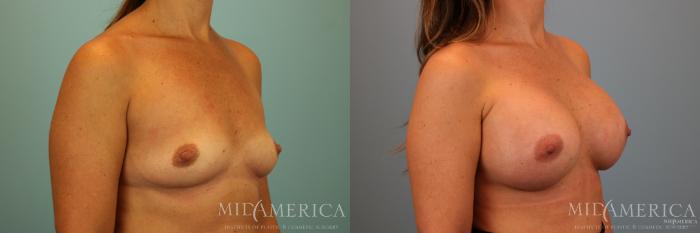 Before & After Breast Augmentation Case 74 View #4 View in Glen Carbon, IL